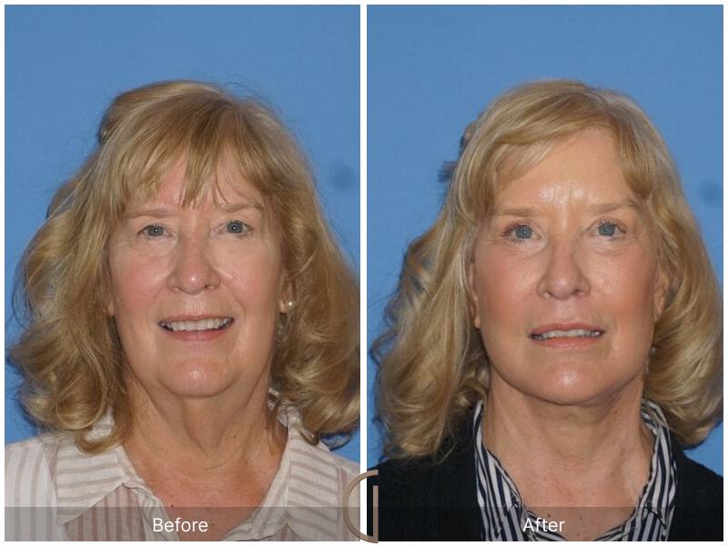 Facelift Sixties Before & After Photo