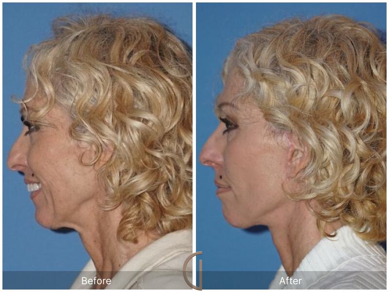 Facelift Sixties Before & After Photo