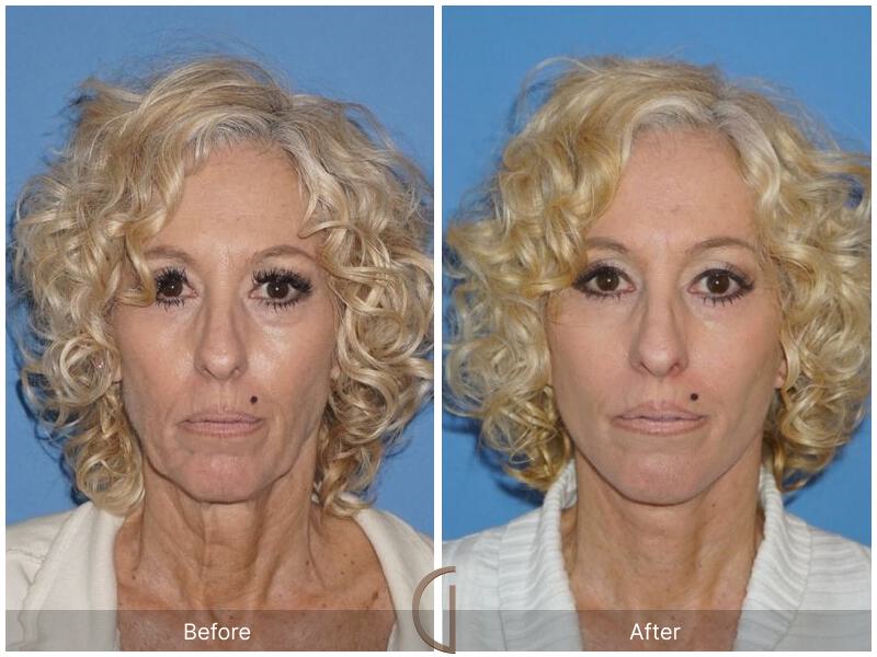 Facelift Sixties Before & After Photo
