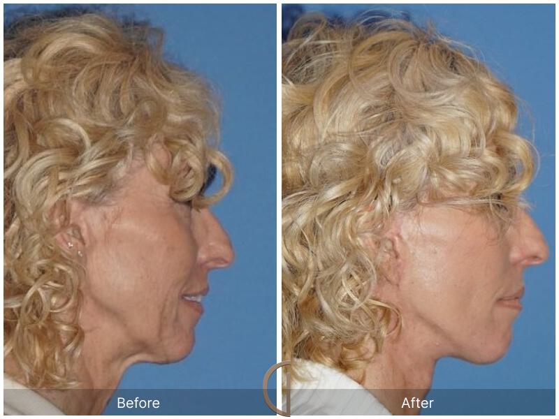 Facelift Sixties Before & After Photo