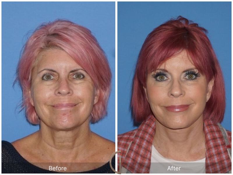 Facelift Sixties Before & After Photo