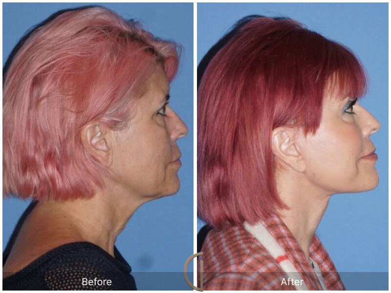 Facelift Sixties Before & After Photo