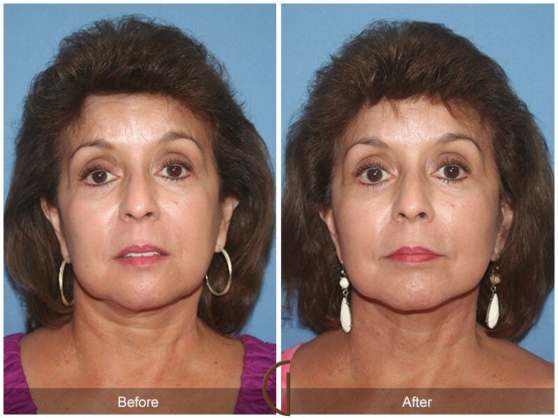 Facelift Sixties Before & After Photo