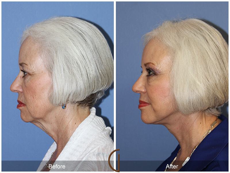 Facelift Seventies  Before & After Photo