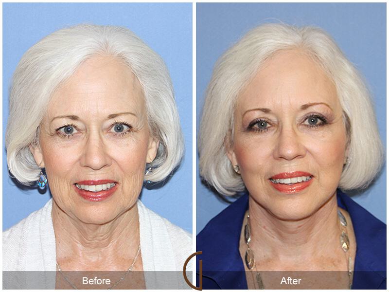 Facelift Seventies  Before & After Photo