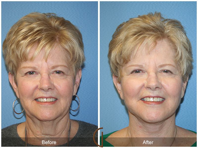 Facelift Seventies  Before & After Photo