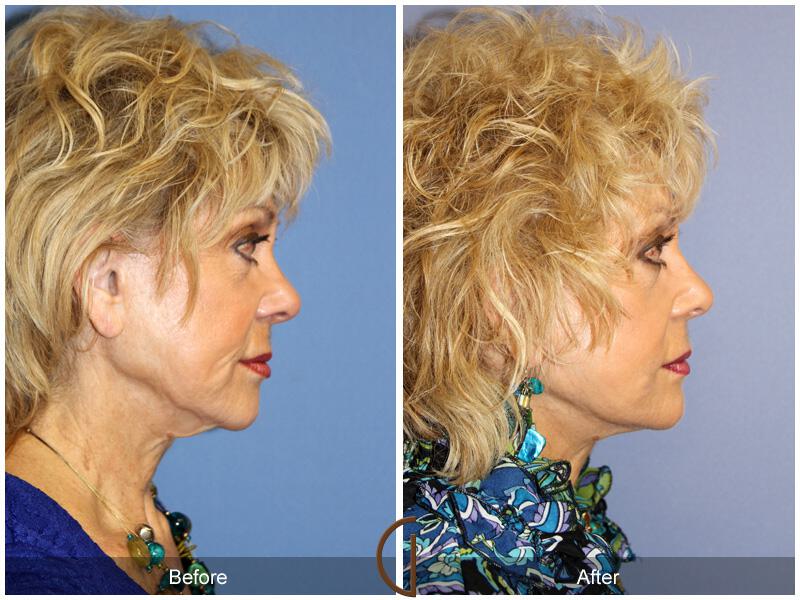 Facelift Seventies  Before & After Photo