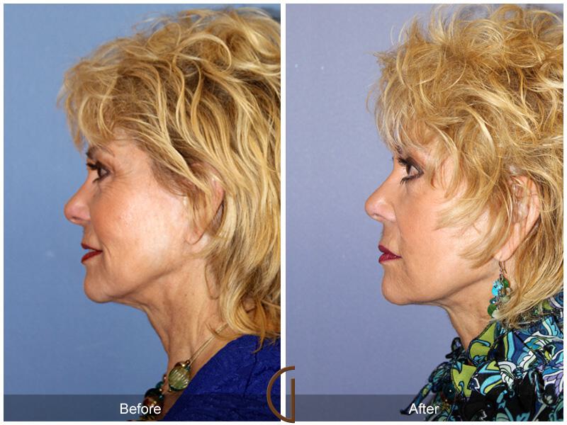 Facelift Seventies  Before & After Photo