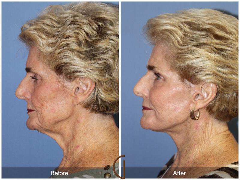 Facelift Seventies  Before & After Photo