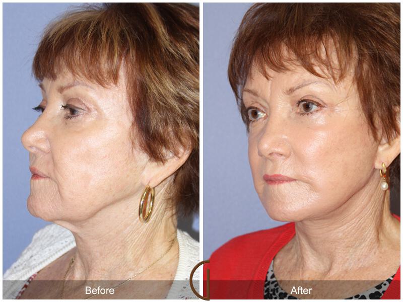 Facelift Seventies  Before & After Photo