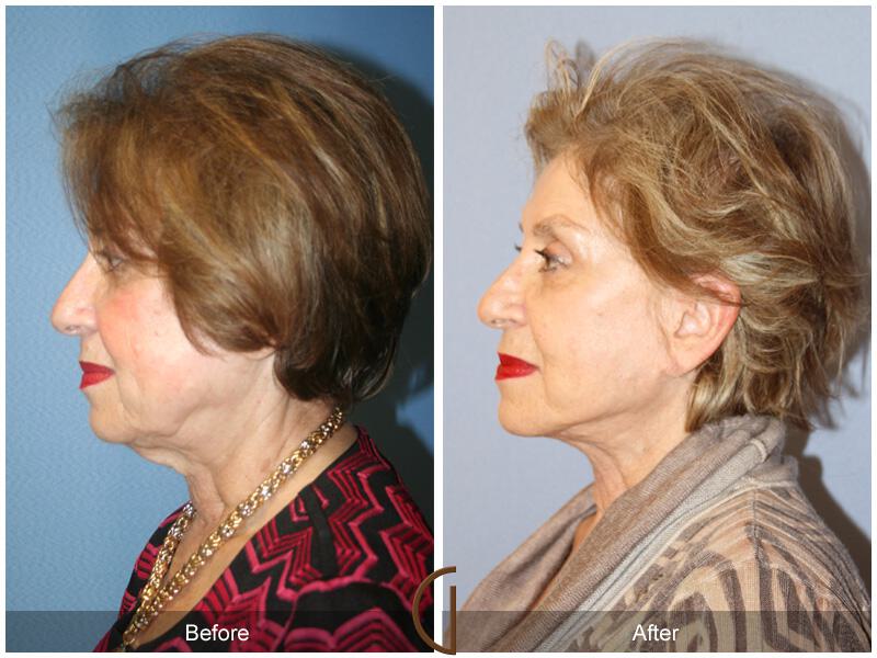 Facelift Seventies  Before & After Photo