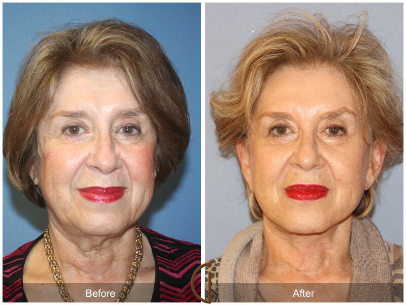 Facelift Seventies  Before & After Photo