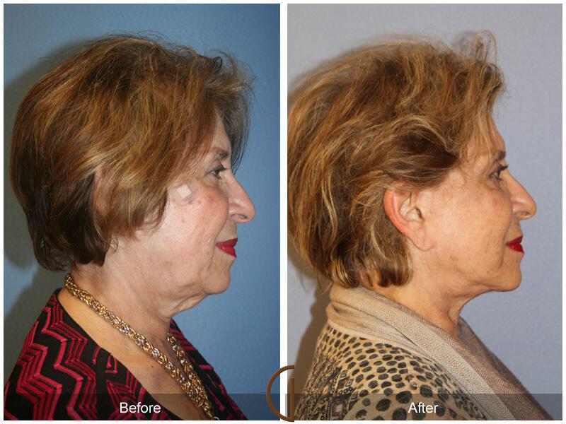 Facelift Seventies  Before & After Photo