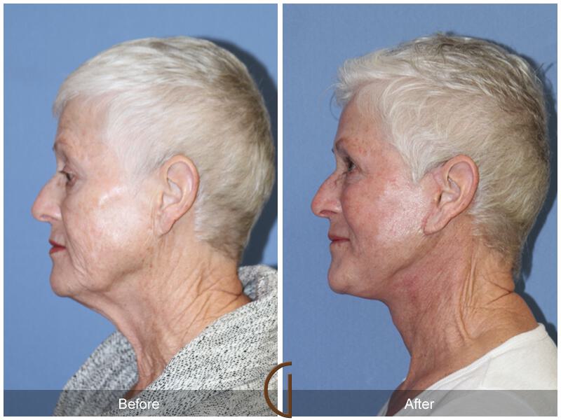 Facelift Seventies  Before & After Photo