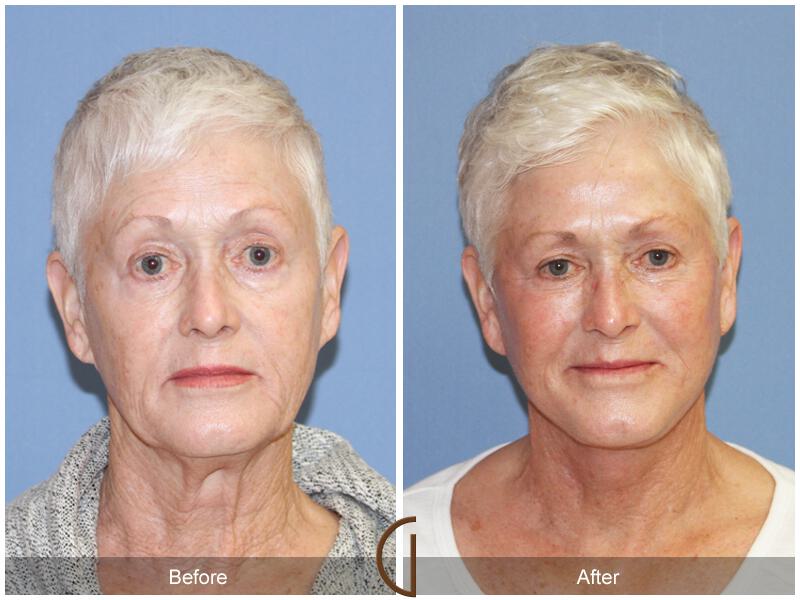 Facelift Seventies  Before & After Photo