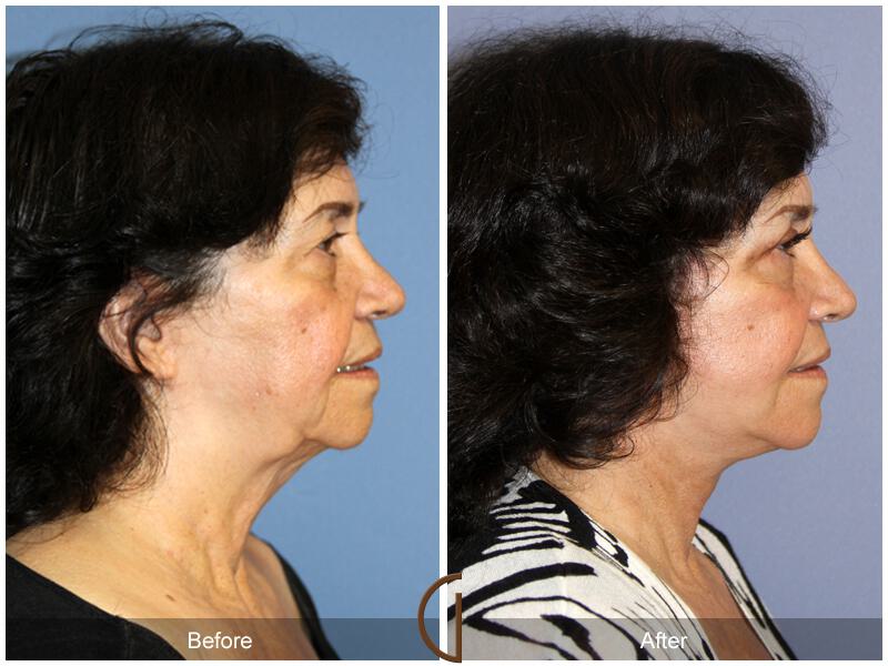 Facelift Seventies  Before & After Photo