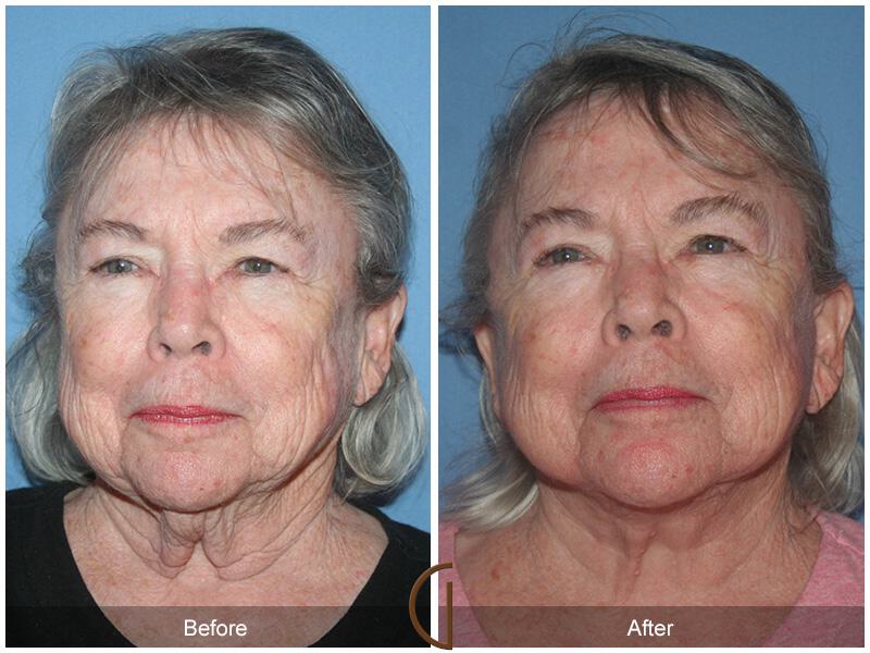 Facelift Seventies  Before & After Photo