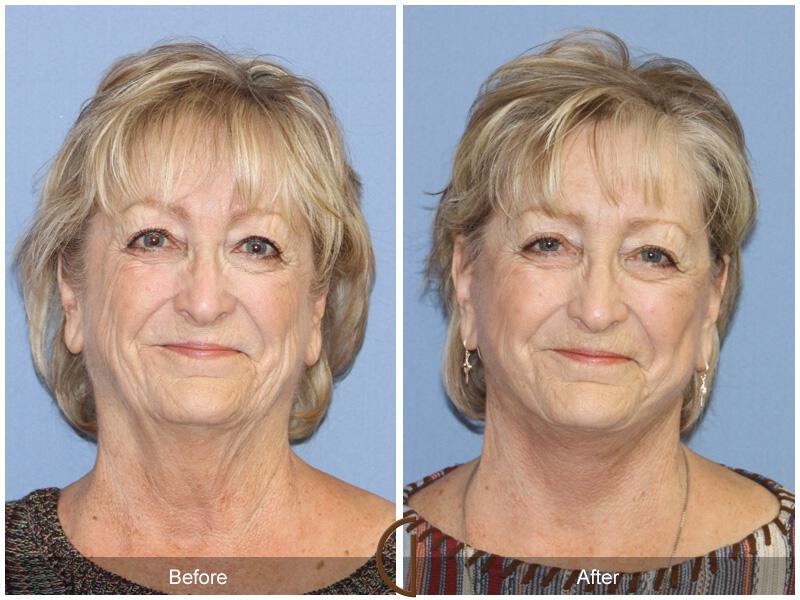 Facelift Seventies  Before & After Photo