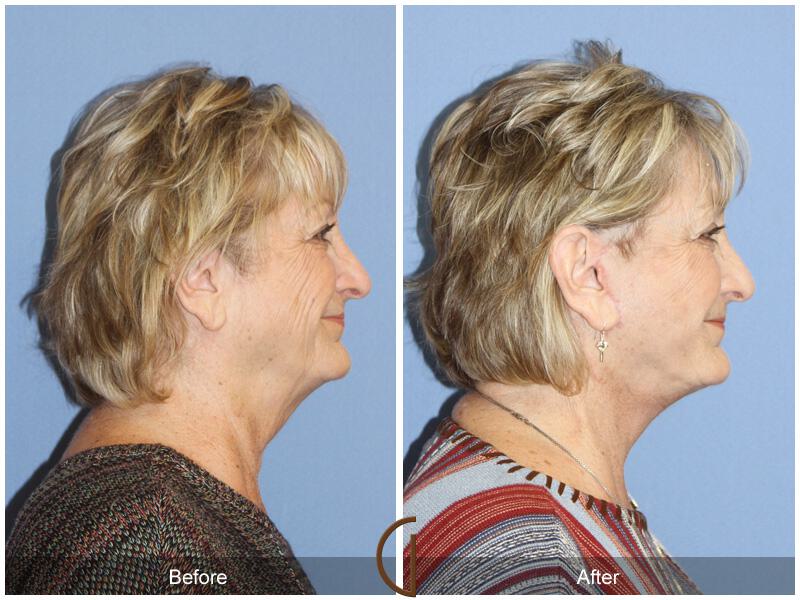 Facelift Seventies  Before & After Photo