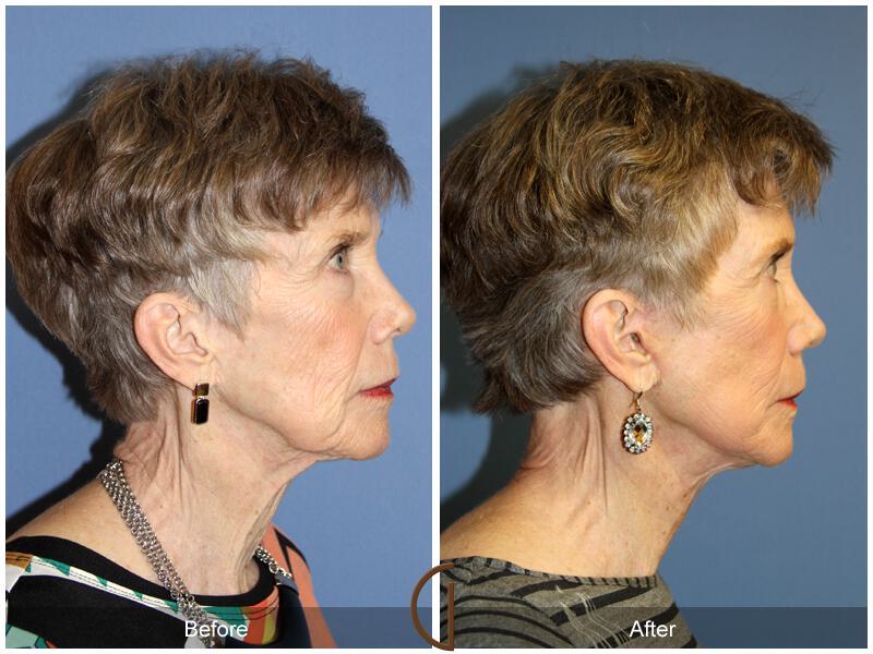 Facelift Seventies  Before & After Photo