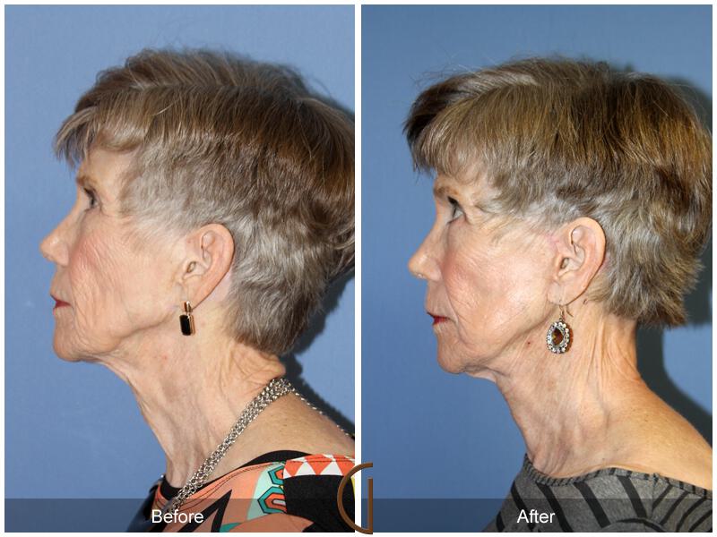 Facelift Seventies  Before & After Photo