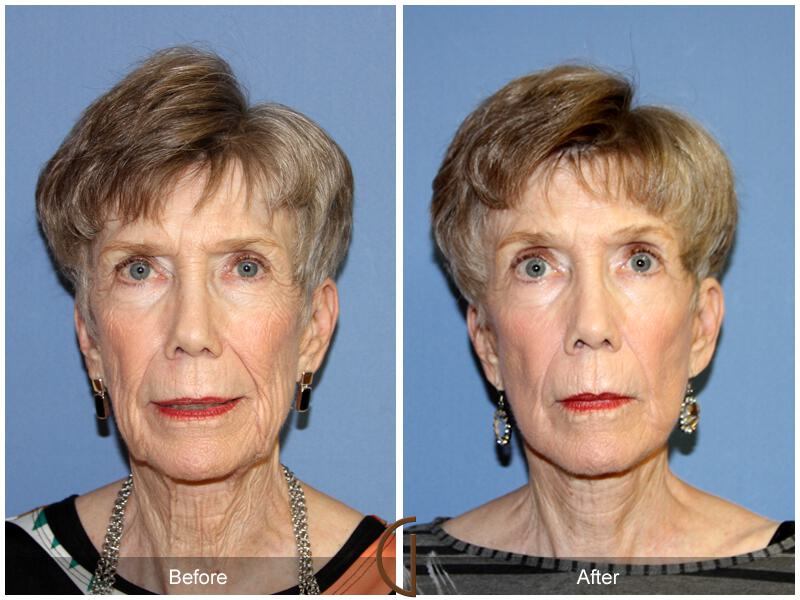 Facelift Seventies  Before & After Photo