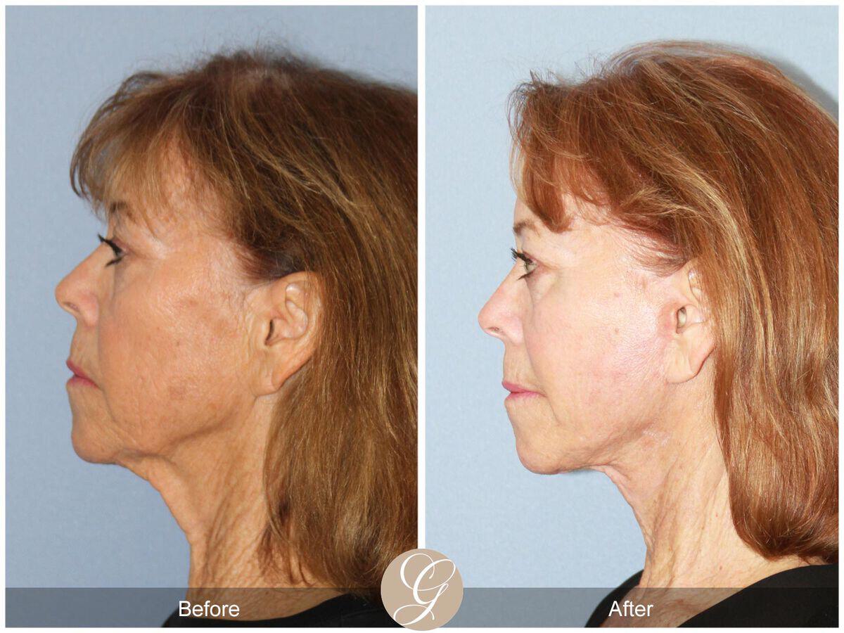 Facelift Seventies  Before & After Photo