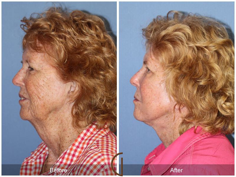 Facelift Seventies  Before & After Photo