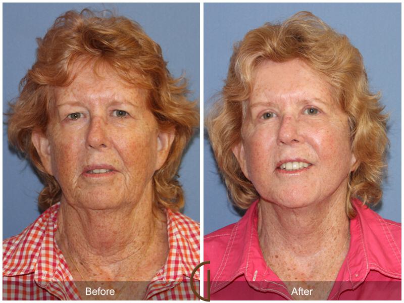 Facelift Seventies  Before & After Photo