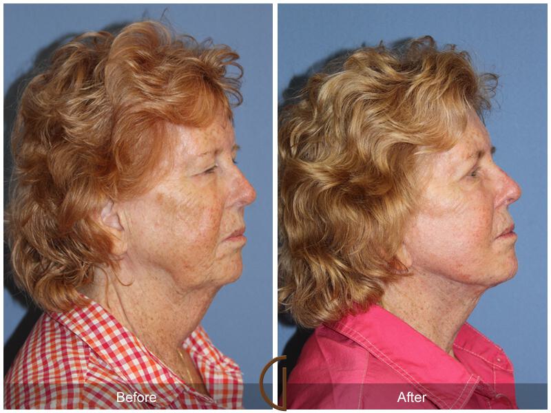 Facelift Seventies  Before & After Photo