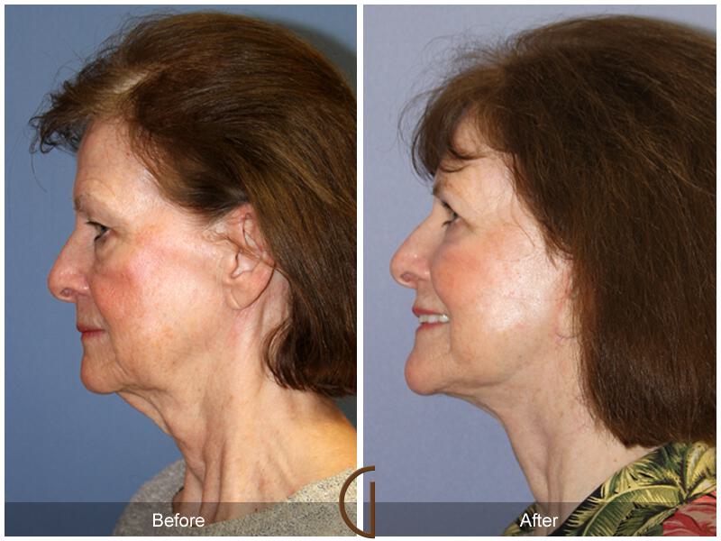 Facelift Seventies  Before & After Photo