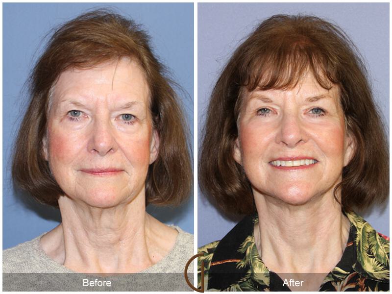 Facelift Seventies  Before & After Photo