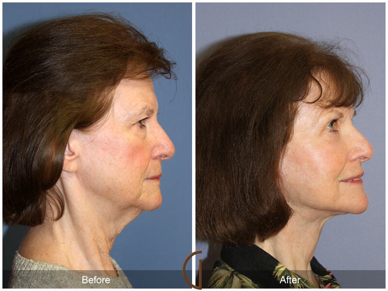 Facelift Seventies  Before & After Photo