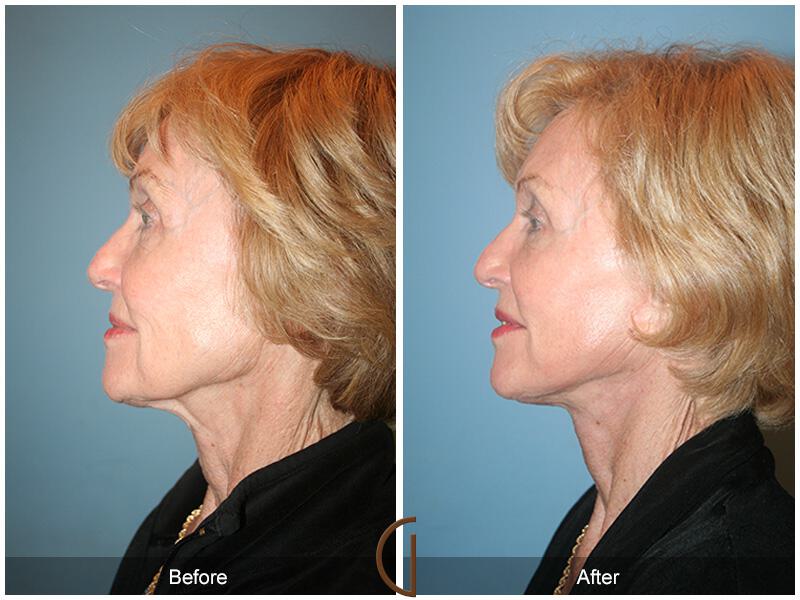 Facelift Seventies  Before & After Photo