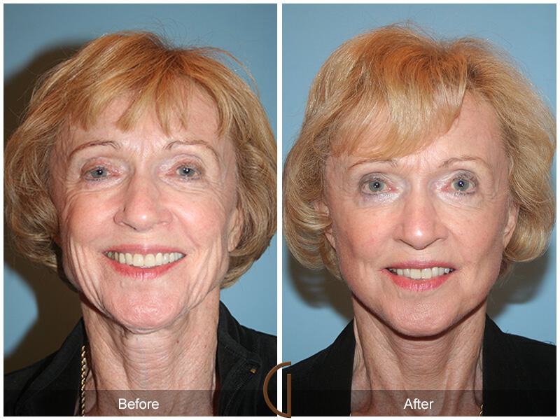 Facelift Seventies  Before & After Photo