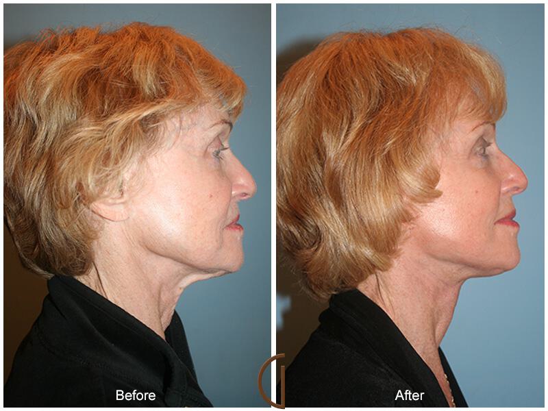 Facelift Seventies  Before & After Photo