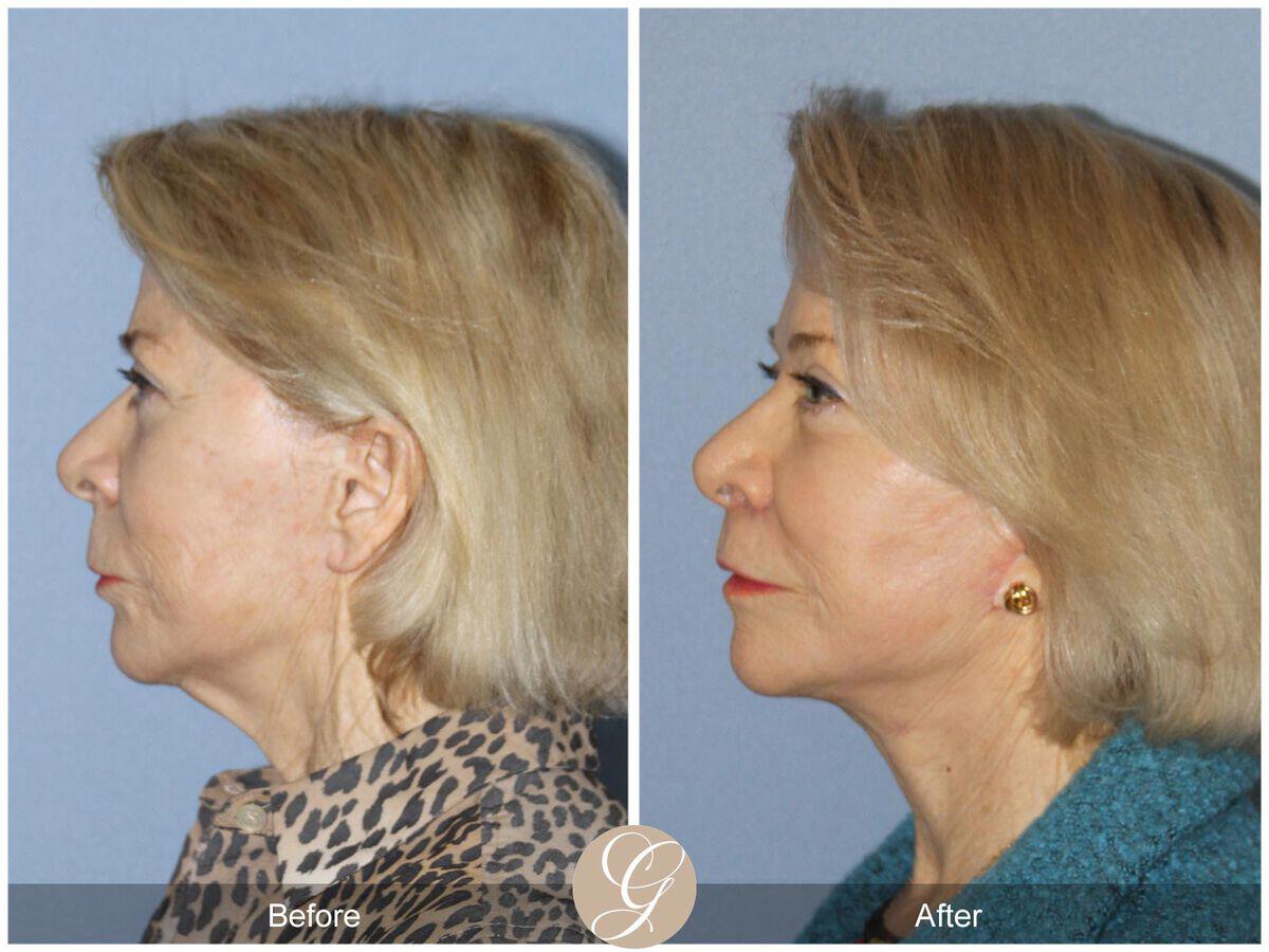 Facelift Seventies  Before & After Photo