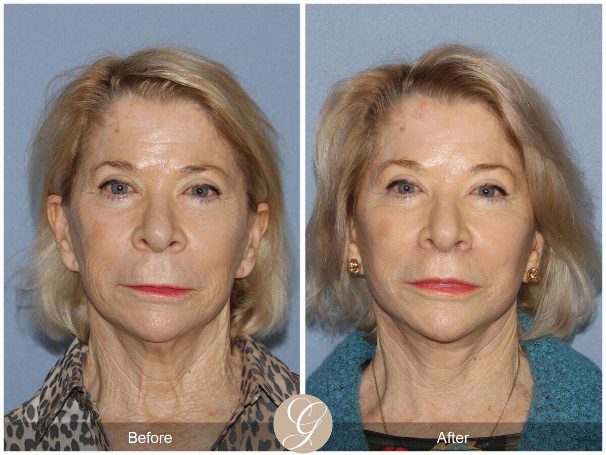 Facelift Seventies  Before & After Photo