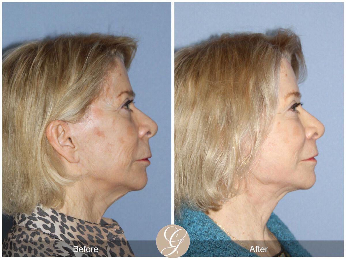 Facelift Seventies  Before & After Photo