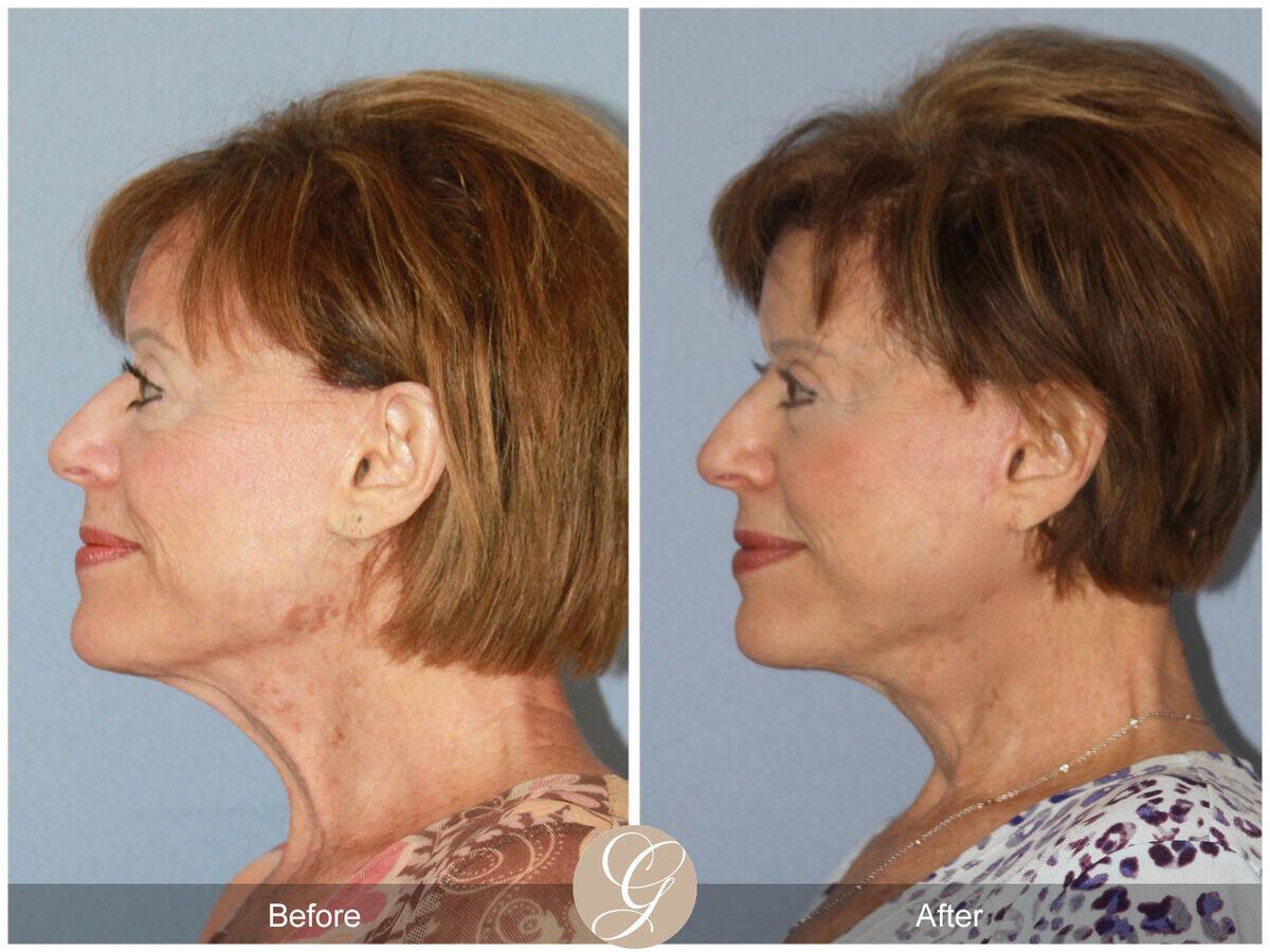 Facelift Seventies  Before & After Photo