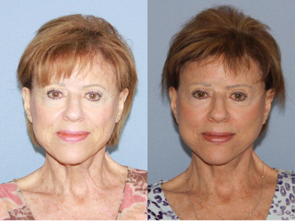 Facelift Seventies  Before & After Photo