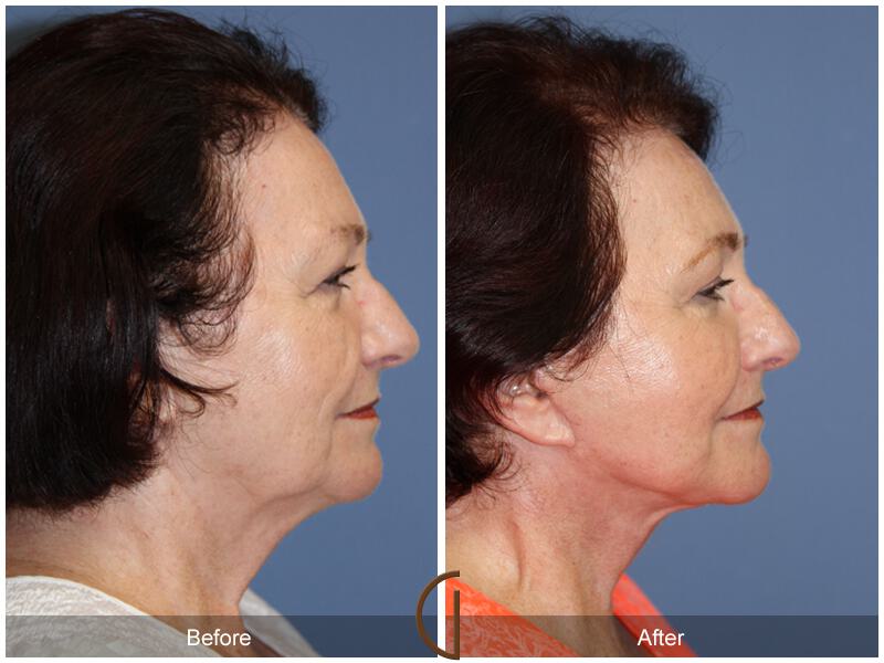 Facelift Seventies  Before & After Photo