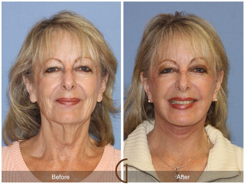 Facelift Seventies  Before & After Photo