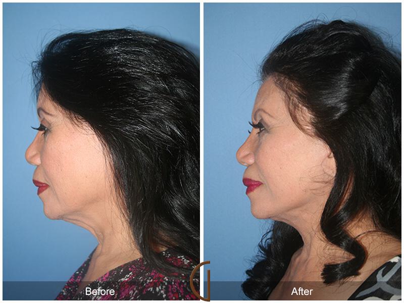 Facelift Seventies  Before & After Photo