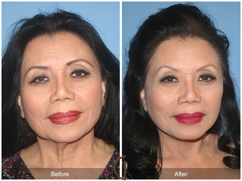 Facelift Seventies  Before & After Photo