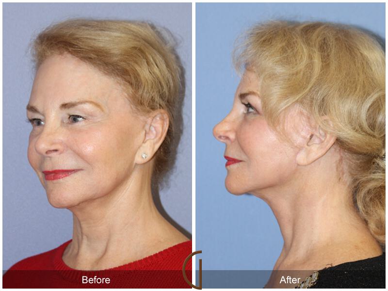 Facelift Seventies  Before & After Photo