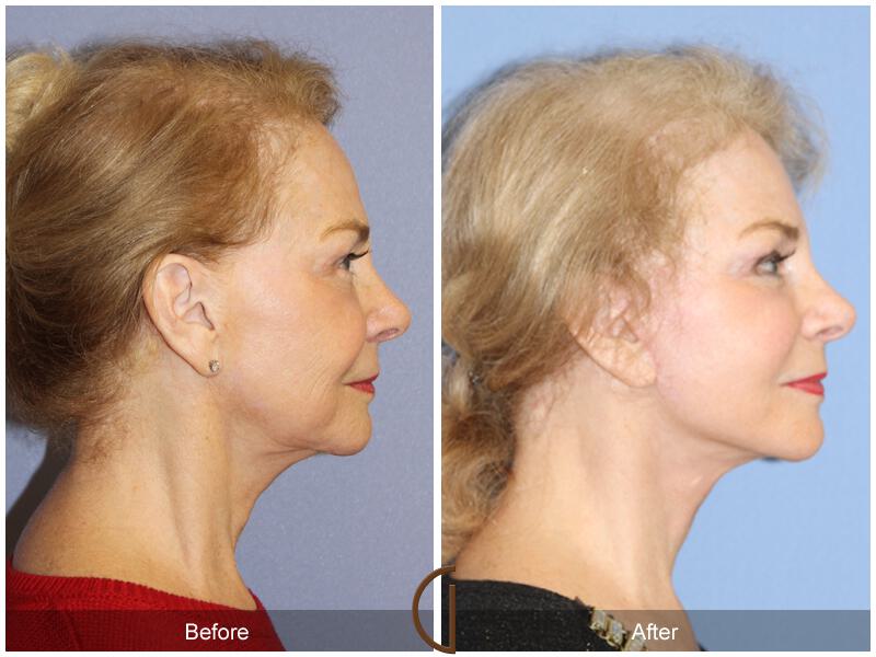 Facelift Seventies  Before & After Photo