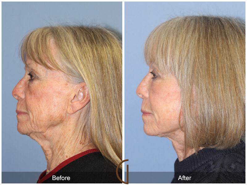 Facelift Seventies  Before & After Photo