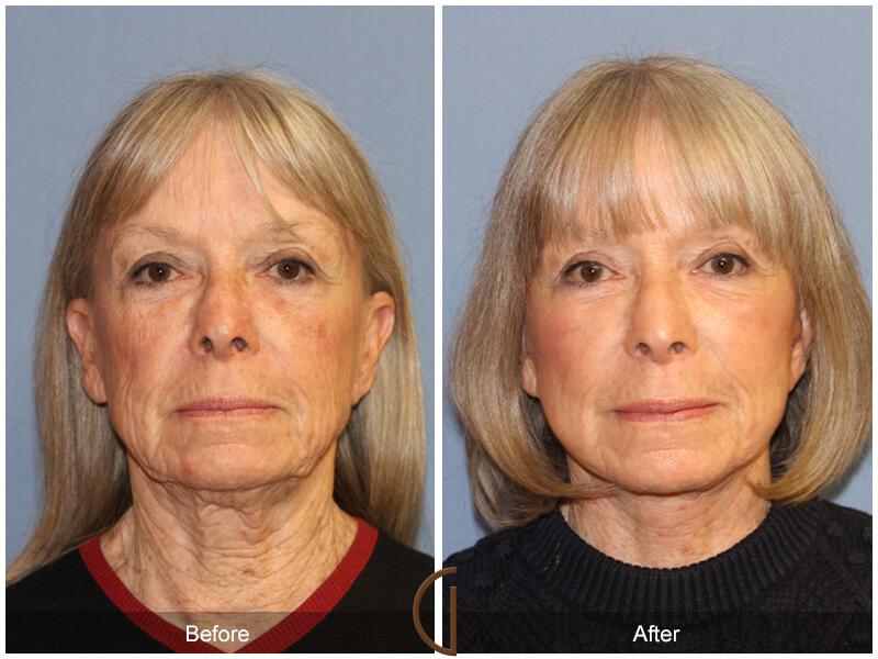 Facelift Seventies  Before & After Photo