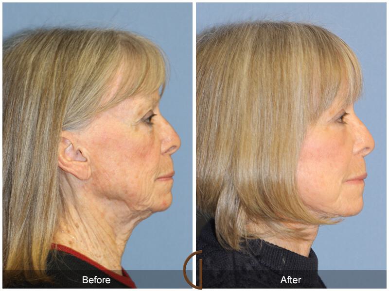 Facelift Seventies  Before & After Photo